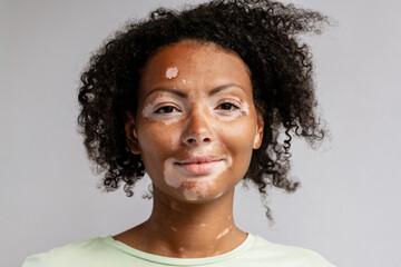 Young woman with vitiligo posing while looking at camera
