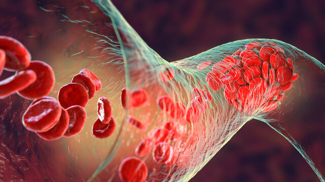 Blood clot made of red blood cells, platelets and fibrin protein strands