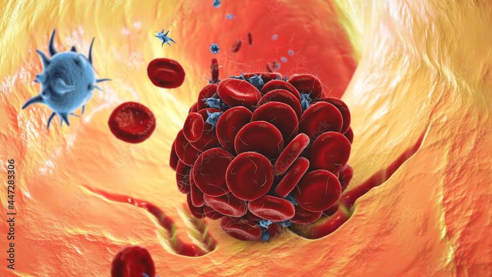 Poster Blood clot in damaged blood vessel made of red blood cells, platelets and fibrin protein strands