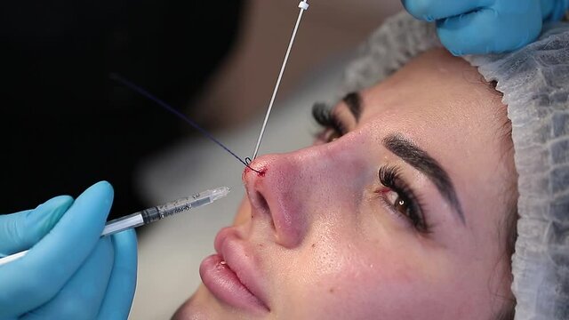 Cosmetic procedure for non-surgical rhinoplasty. A beautician gives injections of anesthetic and inserts cosmetic threads into the nose with a needle to reshape the nose, close-up