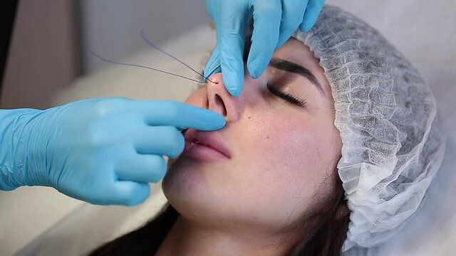 Cosmetic procedure for non-surgical rhinoplasty. The beautician inserts cosmetic threads into the nose with a needle to reshape the nose, close-up. Plastic surgery, cosmetology