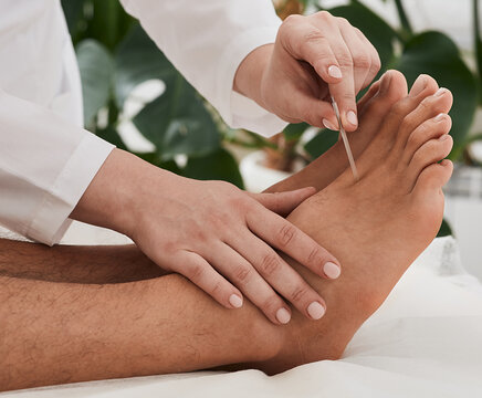 Acupuncture Treatment For Chronic Foot Pain. Chiropractor Doing Acupuncture Therapy For Patient Feet With Needles. Reflexology