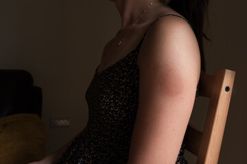 London, City of London, United Kingdom - 26 July 2021: Woman arm redness after second injection of Pfizer vaccine.