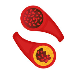 Normal blood vessel versus artery with cholesterol plaque buildup. Narrowed blood vein blocked with a clot. High cholesterol level as atherosclerotic risk. Medical concept. Vector illustration.