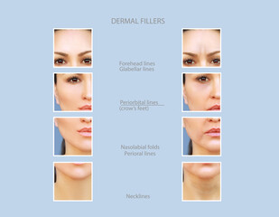 dermal filler treatments .Hyaluronic acid injections for specific areas.Effects of...