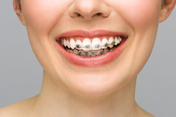 Obraz premium Orthodontic Treatment. Dental Care Concept. Beautiful Woman Healthy Smile close up. Closeup Ceramic and Metal Brackets on Teeth. Beautiful Female Smile with Braces.