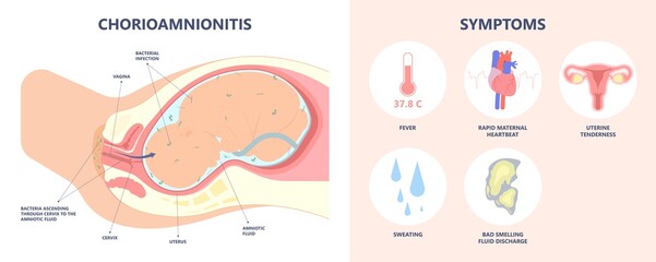 sepsis birth preterm atony baby intra bacteria women water breaks labor fetus fluid mother poly microbial disease urinary tract E. coli genital vagina uterus health Group B Strep amnion Fetal system