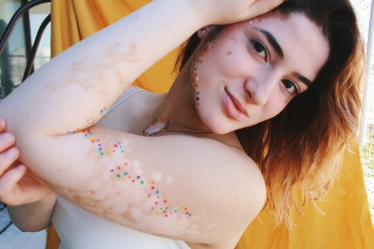  portrait of young woman with vitiligo on skin & colorful body paint and yellow  background 