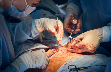 Close up of doctor and assistant in gloves placing sutures after tummy tuck surgery in hospital....
