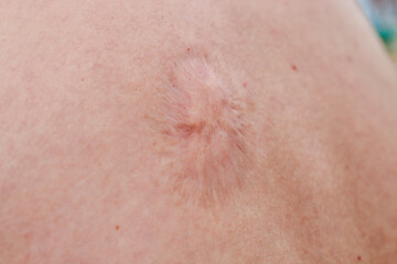 Fototapeta premium scar from removal of papilloma on the back of a person.