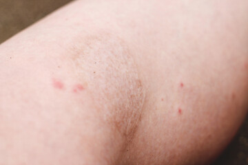 Fototapeta premium a large scar on the leg from a burn after 3 years.