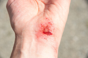 Fototapeta premium Bloody wound on the palm, arm, wrist after an accident or fall. Sport injury - painful hand wound accident