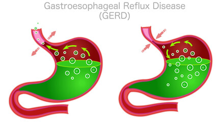 Gastroesophageal Reflux Disease GERD. Stomach anatomy structure. Digestive system organ section diagram. Red body, green liquid gas bubbles. Gastric illness. Medical draw graphic. Illustration vector