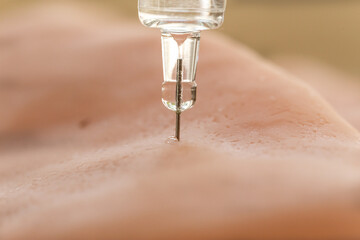 Close-up of an injection.  Administer medication with help of a syringe.
