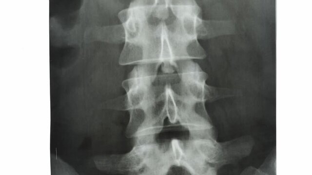 Camera movement along the spine X-ray. Vertical tracking of spinal column and pelvic bones against background of light screen or negatoscope.