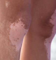 Pigmented spots on the legs of a person.