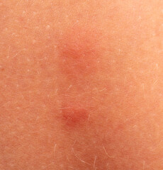 A wound on the skin of a person.