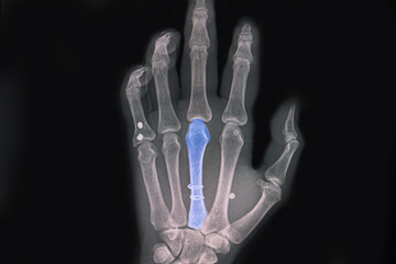 Hand xray showing spiral fractured third metacarpal bone