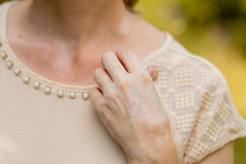 Hand skin pigmentation. White-brown leather. Melasma. Benign pigmentation. Hormonal Disorders. Medical concept.