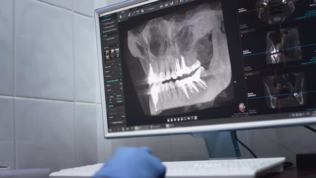 Dentist doctor examines a panoramic x-ray of the jaw on a computer screen. The doctor shows a 3D model of the patient's mouth, MRI scan. Diagnostic equipment for teeth in a modern dental clinic.