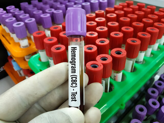 Doctor holding blood sample tube ForCBC, Hemogram,HCT, MCV Hematrocrit,MCH, Total count of WBC...