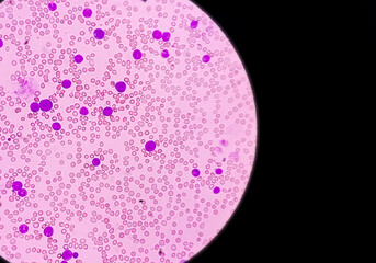 Acute lymphocytic leukemia (ALL) is a type of blood cancer, Microscopic examination of blasts or...