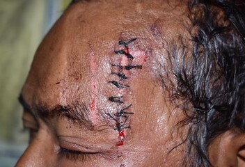 Stitched wound and abrasions in temporal area of Southeast Asian man.