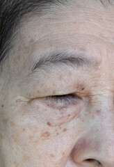 Aging skin folds or skin creases or wrinkles and aging spots at face especially around eye of Southeast Asian, Chinese elderly woman.
