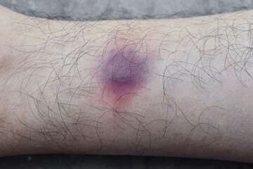 Bruise in leg of Asian Burmese male patient.
