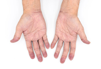 Cyanotic hands or central cyanosis or blue hands at Asian young man with congenital heart disease.