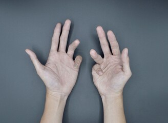 Bilateral Dupuytren’s contracture in Asian young man. Bilateral hand deformities. Abnormal...