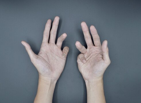 Bilateral Dupuytren’s contracture in Asian young man. Bilateral hand deformities. Abnormal fingers flexion.