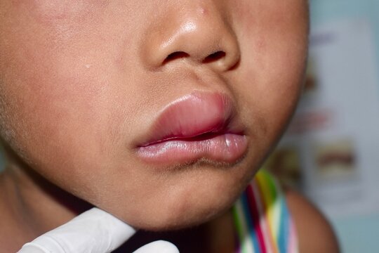 Angioedema at lips of Asian male child. Edematous child. Caused by drug, seafood or chemical allergy and insect bite. Lateral view.