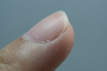 Dry skin, dry fingernails, flaky nose and nails.