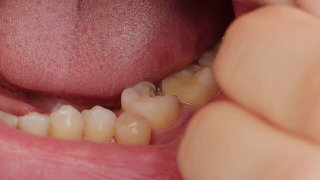 Deep caries in the patient's jaw tooth and displacement of the crooked tooth. Dental treatment concept in dentistry, macro