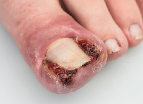 ingrowing toenail