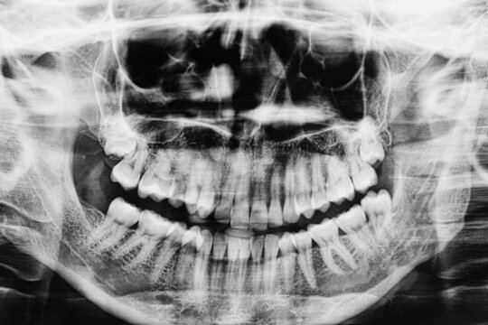 Different types of wisdom teeth problems concept. Teeth X-ray image scanned. Wisdom tooth crashed into a molar. Orthopantomography