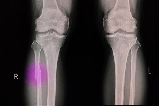 X -ray film of a knee of a patient with fractured proximal fibula
