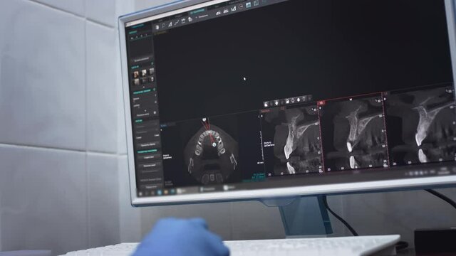 Dentist doctor examines a panoramic x-ray of the jaw on a computer screen. The doctor shows a 3D model of the patient's mouth, MRI scan. Diagnostic equipment for teeth in a modern dental clinic.