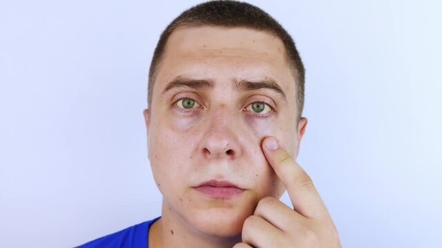 The yellow color of the man eye. Symptom of jaundice, hepatitis or problems with the gall bladder, gastrointestinal tract, liver. Yellow eye in diseases of the liver, cirrhosis, hepatitis, bilirubin