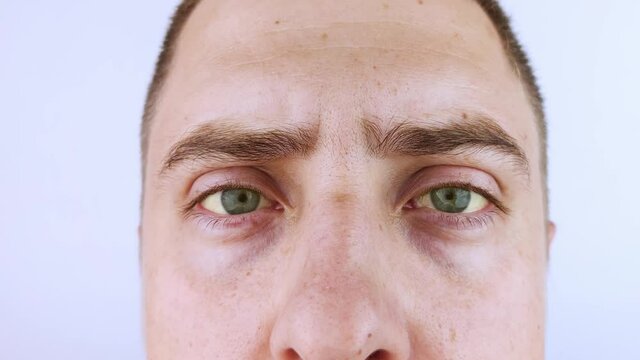 The yellow color of the man eye. Symptom of jaundice, hepatitis or problems with the gall bladder, gastrointestinal tract, liver. Yellow eye in diseases of the liver, cirrhosis, hepatitis, bilirubin
