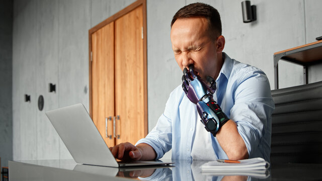 Disabled Programmer With Bio Hand High Tech Prothesis Solves Problem Typing On Laptop