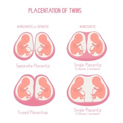 Placentation of twins flat illustration