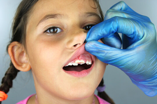 Seven year old girl with shark teeth 