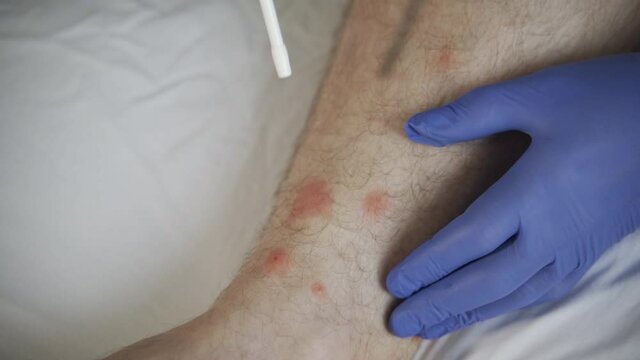 Skin inflammation on male's leg, red sore caused by insect, bed bugs, mosquito or flea bites. Skin infection and feeling itchy, parasites attacked human leg. Allergy and dermatology concept