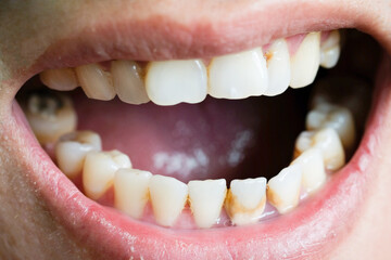 Tooth's a man smoking bad. Man smokes a cigarettes have tooth decay and calculus on teeth, So we...