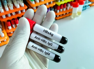 Scientist hold blood samples for HBsAg, Anti HBc IgG and Anti HBc IgM test. Hepatitis B Antigen and...