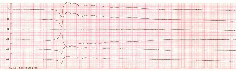 ECG tape with single idioventricular complex and ventricular asystole