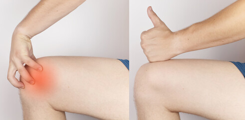 Naklejka premium Before and after. On the left, a man is holding onto an injured knee, and on the right, doctors have already cured a patient. Ruptured knee tendons, muscles, meniscus injury, bone fracture or fissure