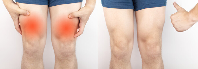Before and after. On the left, a man has acute pain in the hip after a muscle strain or tear. On...